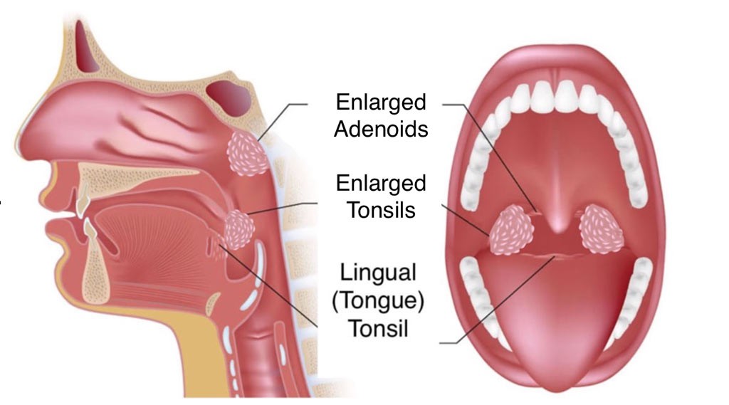 Enlarged Tonsils Adult 55